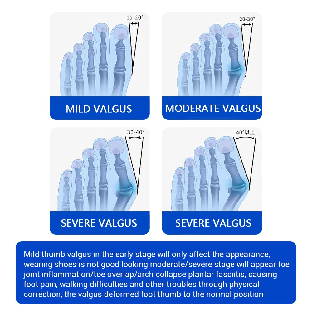 Orthopedic Bunion Corrector Toe Straightener
